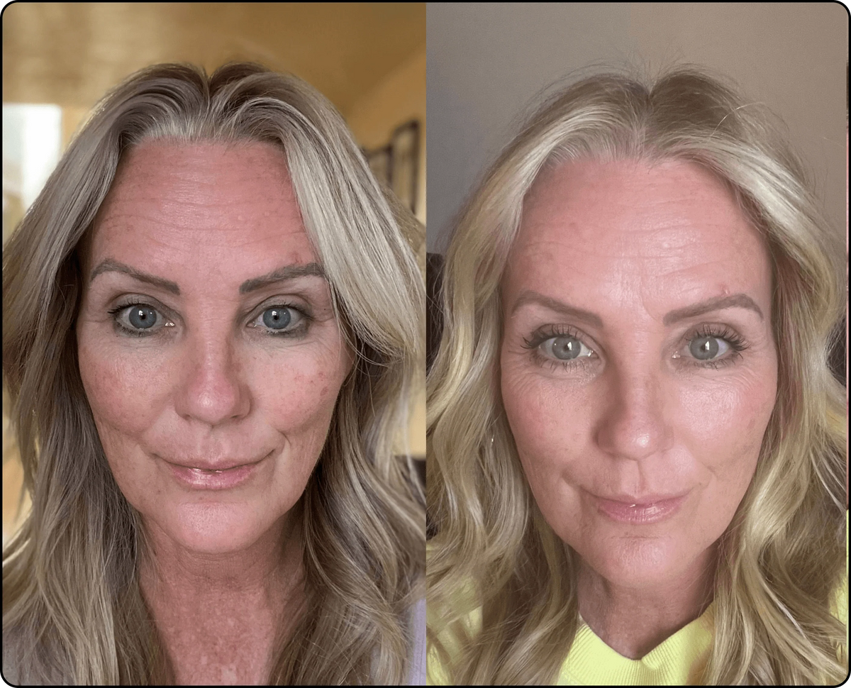 Before and After - Sarah M. — New York, USA