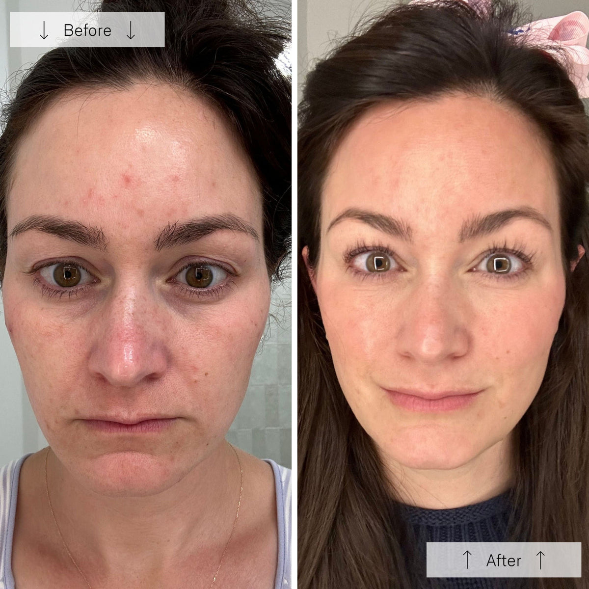 Before and After - Emily R. — London, UK